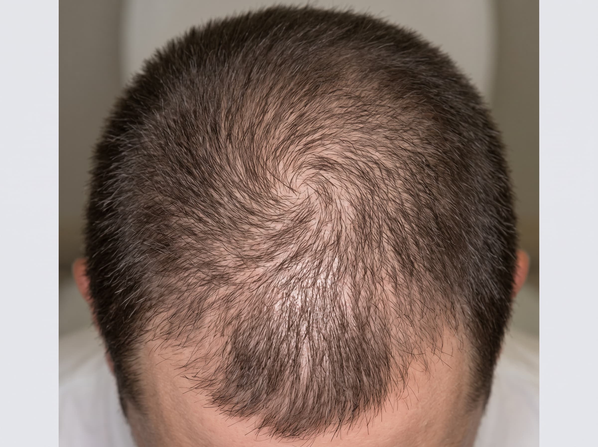 A standardized top-down photograph of a crown, the region HairProof measures